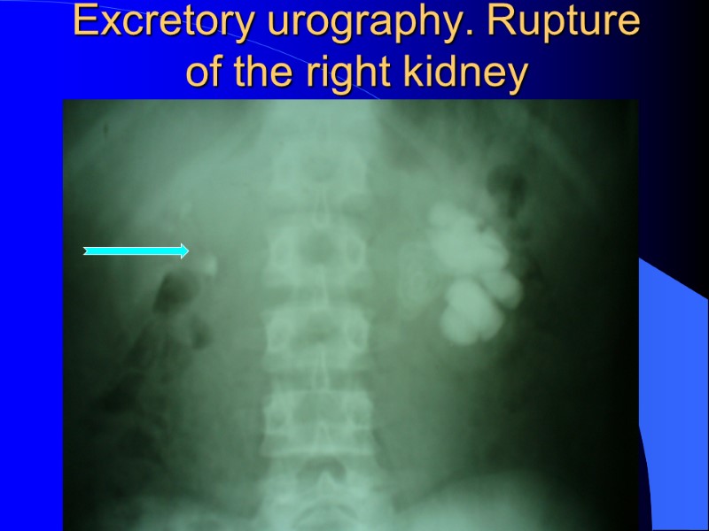Excretory urography. Rupture of the right kidney Excretory urography. Rupture of the right kidney
